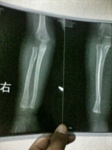 yao yao broken arm2